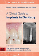 A Clinical Guide to Implants in Dentistry