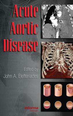 Acute Aortic Disease - Elefteriades, John (Editor)
