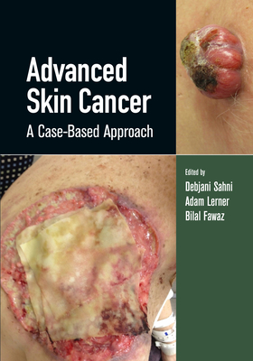 Advanced Skin Cancer: A Case-Based Approach - Sahni, Debjani (Editor), and Lerner, Adam (Editor)