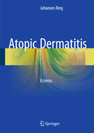 Atopic Dermatitis: Eczema