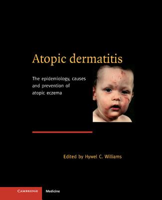 Atopic Dermatitis - Williams, Hywel C (Editor)