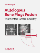 Autologous Bone Plugs Fusion: Treatment for Lumbar Instability