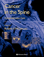 Cancer in the Spine: Comprehensive Care