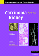 Carcinoma of the Kidney