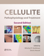 Cellulite: Pathophysiology and Treatment