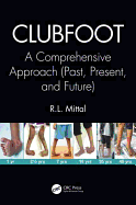 Clubfoot: A Comprehensive Approach (Past, Present, and Future)