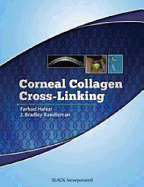 Corneal Collagen Cross Linking