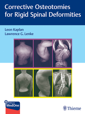 Corrective Osteotomies for Rigid Spinal Deformities - Kaplan, Leon (Editor), and Lenke, Lawrence G. (Editor)