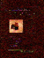 Cutaneous Melanoma