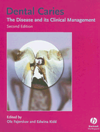 Dental Caries: The Disease and Its Clinical Management