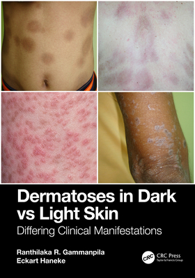 Dermatoses in Dark Vs Light Skin: Differing Clinical Manifestations - Gammanpila, Ranthilaka R, and Haneke, Eckart