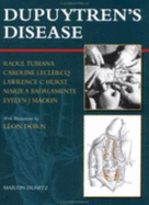 Dupuytren's Disease