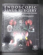 Endoscopic Sinus Surgery: Optimizing Outcomes and Avoiding Failures