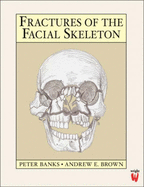 Fractures of the Facial Skeleton