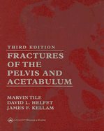 Fractures of the Pelvis and Acetabulum