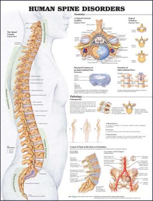 Human Spine Disorders Anatomical Chart - Acc, and Anatomical Chart Company (Prepared for publication by), and Acc Anatomical Chart Company