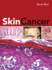 Skin Cancer