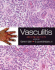 Vasculitis