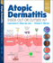 Atopic Dermatitis Inside Out Or Outside in? With Access Code (Hb 2023)
