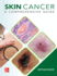 Skin Cancer: a Comprehensive Guide