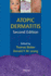 Atopic Dermatitis