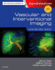 Saad-Vascular and Interventional Imaging: Case Review Series-3e