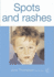 Spots, Birthmarks and Rashes: Concentrates on the Causes and Treatment of Childrens Skin Conditions