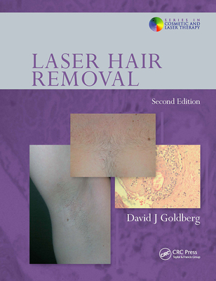 Laser Hair Removal - Goldberg, David J (Editor)