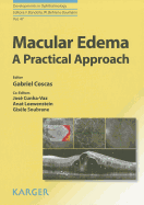 Macular Edema: A Practical Approach