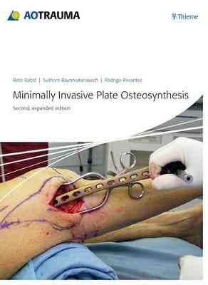Minimally Invasive Plate Ostheosynthesis - Babst, Reto, and Bavonratanavech, Suthorn, and Pesantez, Rodrigo F.