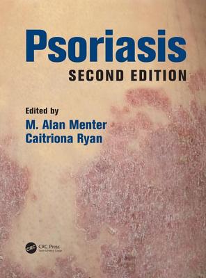 Psoriasis - Menter, M. Alan (Editor), and Ryan, Caitriona (Editor)