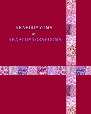 Rhabdomyoma & Rhabdomyosarcoma - Matevosyan, Naira Roland, Dr.
