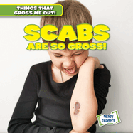 Scabs Are So Gross!