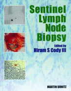 Sentinel Lymph Node Biopsy