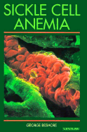 Sickle Cell Anemia
