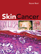 Skin Cancer