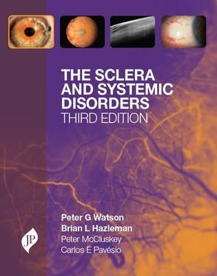 The Sclera and Systemic Disorders - Watson, Peter G, and Hazleman, Brian L, and Pavesio, Carlos E