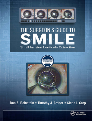 The Surgeon's Guide to Smile: Small Incision Lenticule Extraction - Reinstein, Dan, and Archer, Timothy, and Carp, Glenn, (Sa)