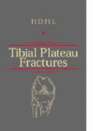 Tibial Plateau Fractures