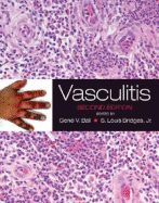 Vasculitis